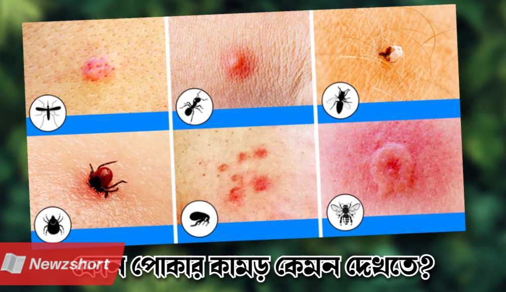 Different Types of Bug Bites and how it looks